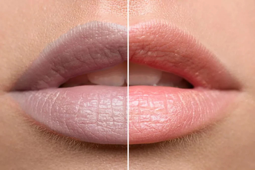 Lip pigmentation treatments in hyderabad