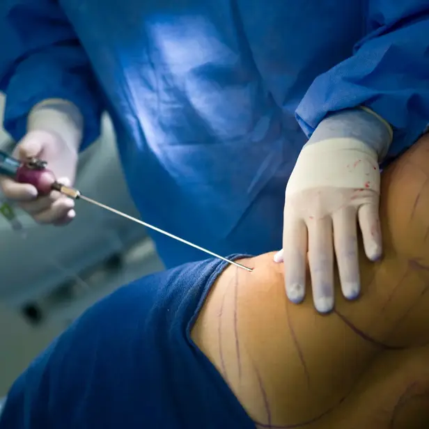 Liposuction