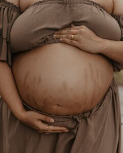 Best Stretch Marks Treatment Clinic in Hyderabad | Evolure Care - Évoluer Aesthetics Stretch Marks