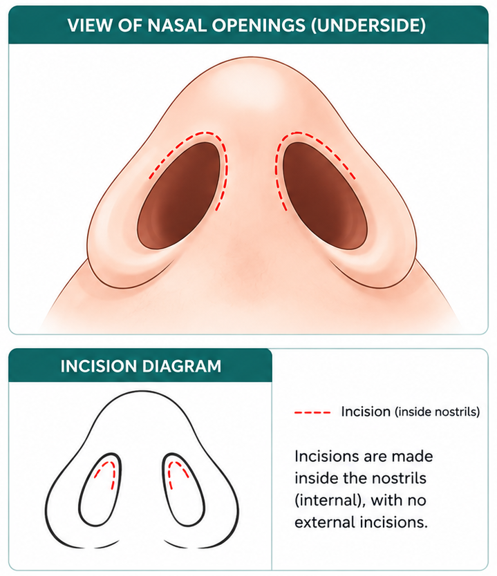 Underside view of nasal openings with red dashed lines marking internal incisions inside the nostrils (medical illustration).